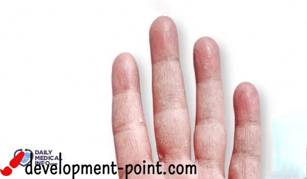 Causes and treatment of peeling skin of the fingers