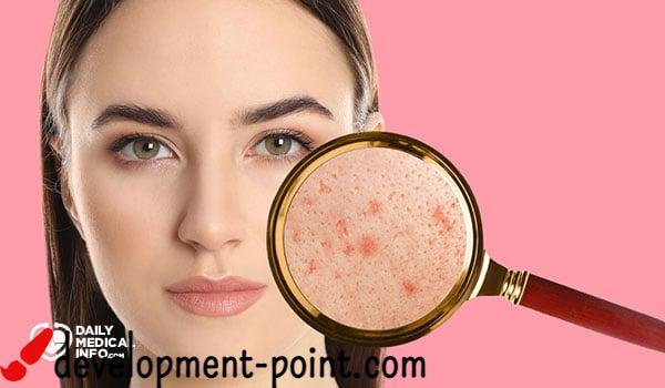 causes-and-treatment-of-pimples-under-the-skin-development-point