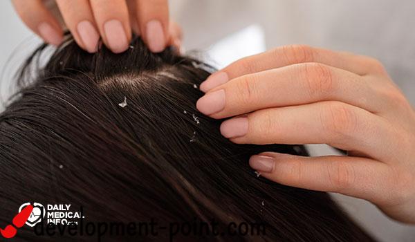 Is it possible to cure dandruff quickly?