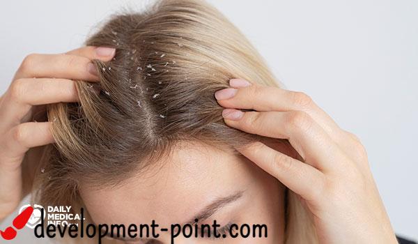 Is it possible to treat dandruff permanently?