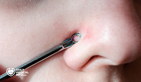 Blackhead removal tool