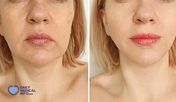 Profile needle before and after
