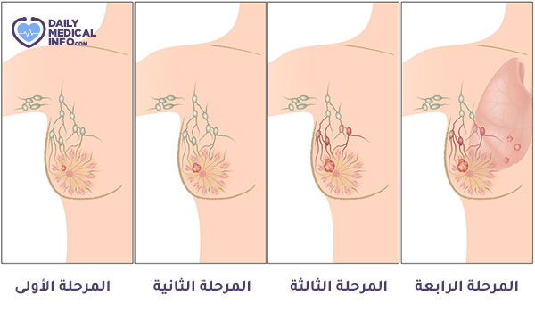 Stages of breast cancer pictures