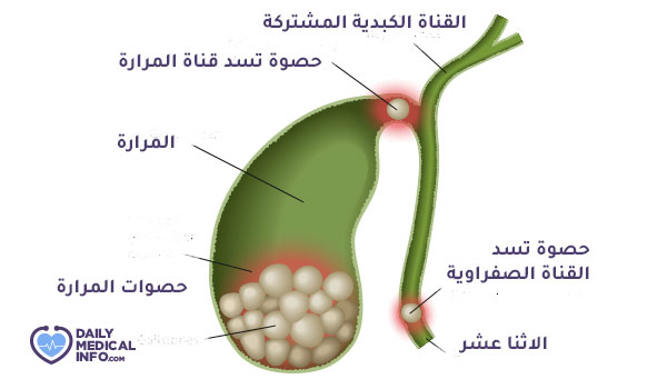 The shape of gallstones