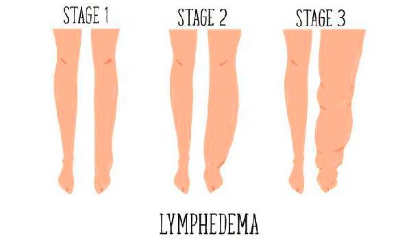 Stages of development of elephantiasis symptoms.