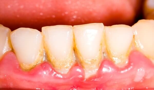 The accumulation of tartar and plaque from the causes of inflammation of the teeth and gums