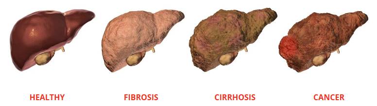 stages of liver disease