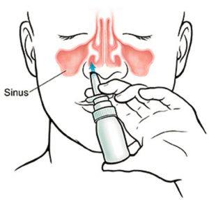 Use a nasal spray