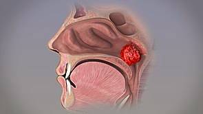 Nasal hypertrophy