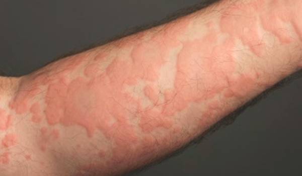 Urticaria sensitivity