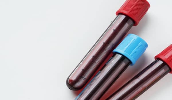 CBC analysis complete blood count