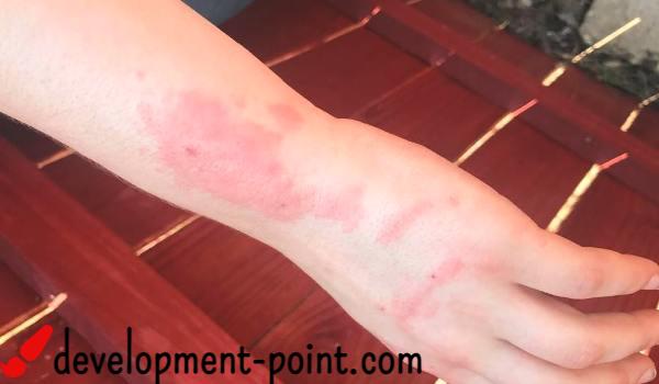 Scabies treatment