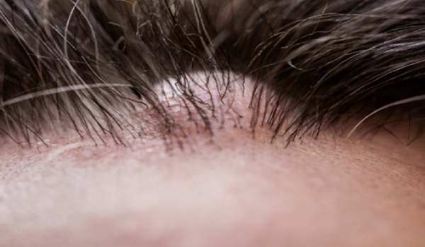 sebaceous cyst