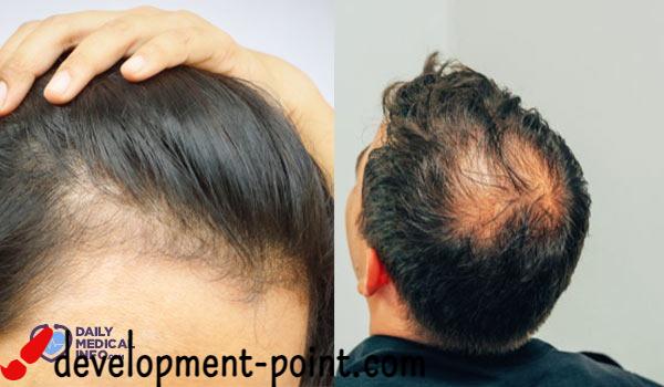 DHT and hair loss